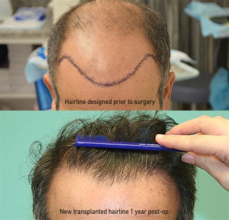 best hair transplant in california.